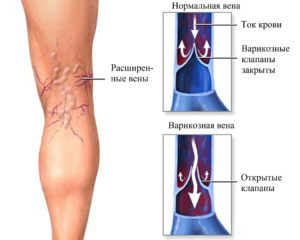 Varicose veins