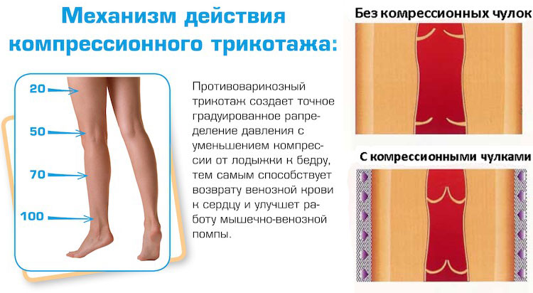 Compression stockings