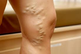 varicose veins