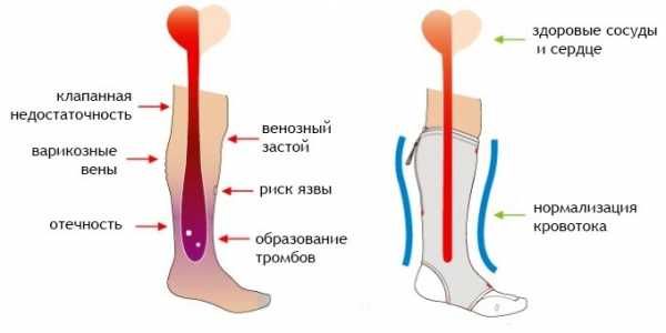 Hangi hastalıklar için kompresyon çorapları