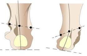 Kaki normal dan varus