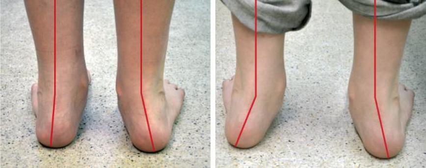 Valgus deformity