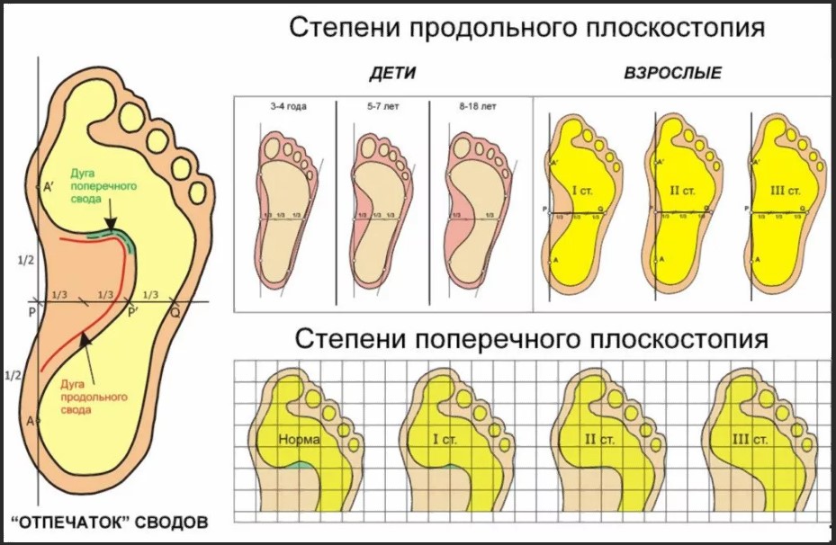 piedi piatti 4