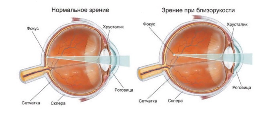 myopia sa paningin