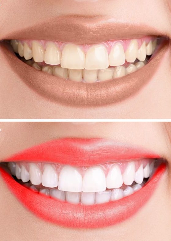 Color de les dents.